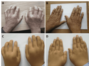 Mãos de paciente com Artrite antes e depois de tratamento com Células Estaminais Mesenquimais