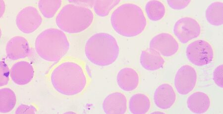 As Células Estaminais no Tratamento de Talassemias - 99