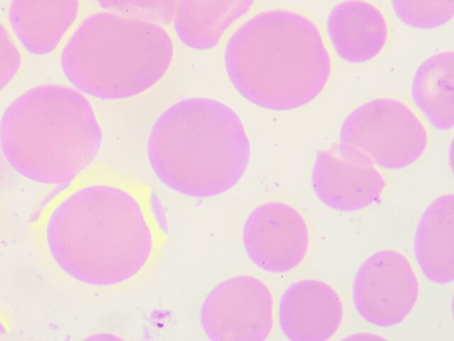 As Células Estaminais no Tratamento de Talassemias - 99