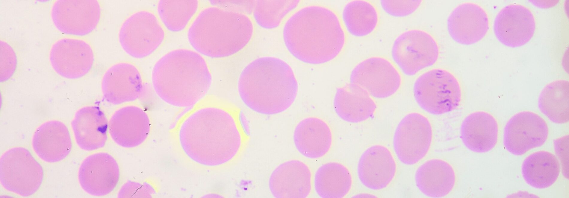 As Células Estaminais no Tratamento de Talassemias - 99