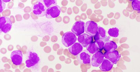 Células estaminais relevam-se alternativa promissora para tratar  leucemia mieloide aguda - 99