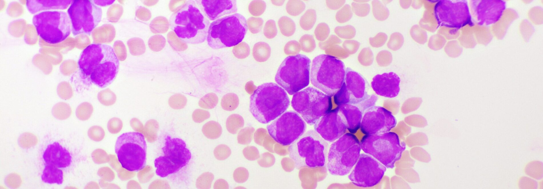 Células estaminais relevam-se alternativa promissora para tratar  leucemia mieloide aguda - 99