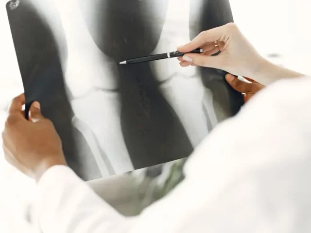 Terapia inovadora para regenerar ossos com células sanguíneas do cordão umbilical