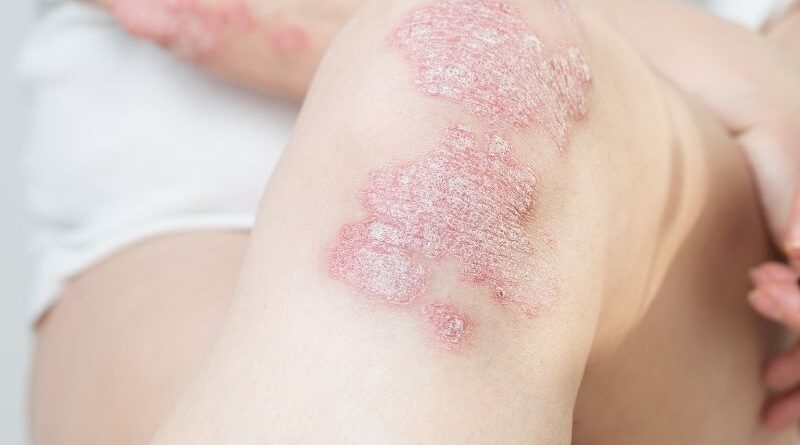 Células estaminais do cordão umbilical no tratamento de psoríase grave Um estudo publicado no British Journal of Dermatology (2026) analisou o potencial terapêutico de células estaminais mesenquimais do tecido do cordão umbilical no tratamento de formas graves de psoríase que não responderam às terapias convencionais. A psoríase é uma doença inflamatória crónica da pele que pode ser difícil de controlar em alguns doentes, mesmo com os tratamentos mais avançados disponíveis. Nesta investigação, os autores exploraram a utilização de células obtidas do cordão umbilical como uma alternativa terapêutica, avaliando a sua capacidade de influenciar a resposta inflamatória subjacente à doença. Os resultados iniciais mostraram que, em determinados casos, a aplicação destas células pode levar a melhorias no quadro clínico de pacientes com psoríase grave que não apresentavam resposta satisfatória às terapias padrão. Estes achados sugerem que a terapia celular pode vir a ser uma abordagem promissora na gestão de formas mais resistentes da doença. Apesar dos resultados encorajadores, os investigadores sublinham que são necessários ensaios clínicos mais amplos e com acompanhamento a longo prazo para confirmar a eficácia e a segurança desta abordagem antes que possa ser adotada de forma generalizada na prática clínica.