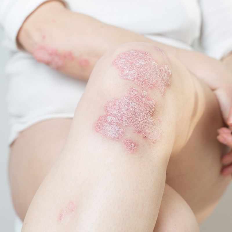 Células estaminais do cordão umbilical no tratamento de psoríase grave Um estudo publicado no British Journal of Dermatology (2026) analisou o potencial terapêutico de células estaminais mesenquimais do tecido do cordão umbilical no tratamento de formas graves de psoríase que não responderam às terapias convencionais. A psoríase é uma doença inflamatória crónica da pele que pode ser difícil de controlar em alguns doentes, mesmo com os tratamentos mais avançados disponíveis. Nesta investigação, os autores exploraram a utilização de células obtidas do cordão umbilical como uma alternativa terapêutica, avaliando a sua capacidade de influenciar a resposta inflamatória subjacente à doença. Os resultados iniciais mostraram que, em determinados casos, a aplicação destas células pode levar a melhorias no quadro clínico de pacientes com psoríase grave que não apresentavam resposta satisfatória às terapias padrão. Estes achados sugerem que a terapia celular pode vir a ser uma abordagem promissora na gestão de formas mais resistentes da doença. Apesar dos resultados encorajadores, os investigadores sublinham que são necessários ensaios clínicos mais amplos e com acompanhamento a longo prazo para confirmar a eficácia e a segurança desta abordagem antes que possa ser adotada de forma generalizada na prática clínica.