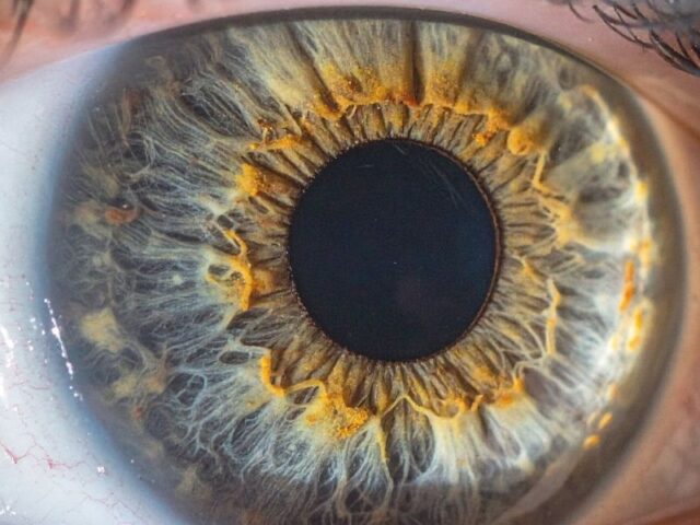 Células estaminais utilizadas no tratamento de doenças da retina Um estudo científico publicado recentemente na plataforma PubMed Central analisou os avanços mais recentes na utilização de células estaminais para o tratamento de doenças degenerativas da retina, abrindo novas perspectivas para o futuro da medicina regenerativa e da recuperação da visão. As doenças da retina, como a degenerescência macular relacionada com a idade, a retinite pigmentosa e a doença de Stargardt, são atualmente responsáveis por uma grande parte dos casos de perda visual progressiva e, na maioria das situações, não têm cura definitiva. Por este motivo, a investigação científica tem vindo a apostar em abordagens inovadoras baseadas em terapias celulares. O estudo destaca a utilização de células estaminais pluripotentes, capazes de se diferenciar em células especializadas da retina, como uma das estratégias mais promissoras para substituir ou regenerar tecidos danificados e, potencialmente, restaurar funções visuais comprometidas. Entre os avanços identificados estão o desenvolvimento de organoides retinianos, novos métodos de diferenciação celular e técnicas de transplante cada vez mais precisas, que permitem melhorar a integração das células na retina após a sua aplicação. Alguns ensaios clínicos iniciais já demonstram resultados encorajadores, com sinais de melhoria funcional em determinados grupos de doentes. Apesar destes progressos, os investigadores sublinham que ainda existem desafios importantes a ultrapassar, nomeadamente no que diz respeito à segurança, estabilidade das células transplantadas e resposta imunológica, sendo necessários mais estudos antes que estas terapias possam ser amplamente utilizadas na prática clínica. Em conclusão, este trabalho reforça o papel das células estaminais como uma das áreas mais promissoras da medicina regenerativa, com potencial para transformar o tratamento de doenças oculares e melhorar significativamente a qualidade de vida de milhares de pessoas no futuro.