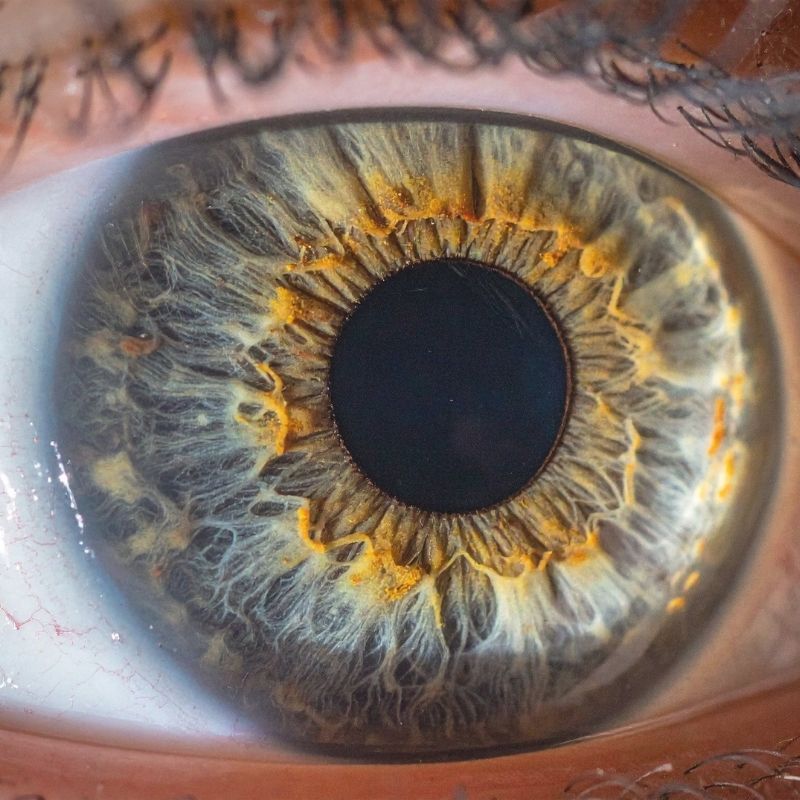 Células estaminais utilizadas no tratamento de doenças da retina Um estudo científico publicado recentemente na plataforma PubMed Central analisou os avanços mais recentes na utilização de células estaminais para o tratamento de doenças degenerativas da retina, abrindo novas perspectivas para o futuro da medicina regenerativa e da recuperação da visão. As doenças da retina, como a degenerescência macular relacionada com a idade, a retinite pigmentosa e a doença de Stargardt, são atualmente responsáveis por uma grande parte dos casos de perda visual progressiva e, na maioria das situações, não têm cura definitiva. Por este motivo, a investigação científica tem vindo a apostar em abordagens inovadoras baseadas em terapias celulares. O estudo destaca a utilização de células estaminais pluripotentes, capazes de se diferenciar em células especializadas da retina, como uma das estratégias mais promissoras para substituir ou regenerar tecidos danificados e, potencialmente, restaurar funções visuais comprometidas. Entre os avanços identificados estão o desenvolvimento de organoides retinianos, novos métodos de diferenciação celular e técnicas de transplante cada vez mais precisas, que permitem melhorar a integração das células na retina após a sua aplicação. Alguns ensaios clínicos iniciais já demonstram resultados encorajadores, com sinais de melhoria funcional em determinados grupos de doentes. Apesar destes progressos, os investigadores sublinham que ainda existem desafios importantes a ultrapassar, nomeadamente no que diz respeito à segurança, estabilidade das células transplantadas e resposta imunológica, sendo necessários mais estudos antes que estas terapias possam ser amplamente utilizadas na prática clínica. Em conclusão, este trabalho reforça o papel das células estaminais como uma das áreas mais promissoras da medicina regenerativa, com potencial para transformar o tratamento de doenças oculares e melhorar significativamente a qualidade de vida de milhares de pessoas no futuro.