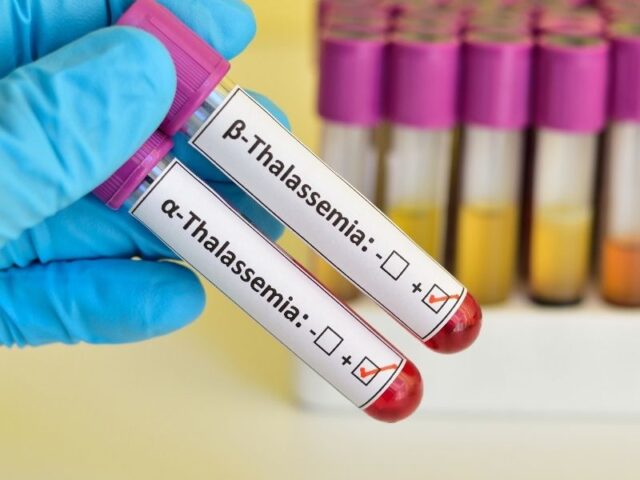 Amostra criopreservada de sangue do cordão umbilical do irmão mais novo permitiu realizar tratamento potencialmente curativo Amostra criopreservada de sangue do cordão umbilical do irmão mais novo permitiu realizar tratamento potencialmente curativo Uma criança diagnosticada com β-talassemia, uma doença genética grave do sangue, recebeu um transplante de células estaminais hematopoiéticas que lhe proporcionou uma nova oportunidade de vida. O procedimento foi possível graças à utilização do sangue do cordão umbilical do seu irmão mais novo, previamente criopreservado logo após o nascimento. A unidade de sangue do cordão umbilical permaneceu armazenada durante mais de dois anos, tendo sido posteriormente libertada quando se confirmou a compatibilidade genética necessária para o tratamento. Após o envio para o hospital onde decorreu o procedimento, o transplante foi realizado com sucesso, permitindo a recuperação clínica da criança. A β-talassemia é uma doença hereditária que afeta a produção normal de hemoglobina e, em muitos casos, o transplante de células estaminais pode representar a única opção terapêutica potencialmente curativa, desde que exista um dador compatível. Este caso clínico reforça o valor da criopreservação do sangue do cordão umbilical como um recurso terapêutico que pode vir a ser determinante no tratamento de diversas doenças hematológicas e genéticas, evidenciando o impacto que decisões tomadas no nascimento podem ter na saúde futura.