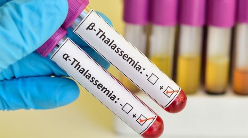 Amostra criopreservada de sangue do cordão umbilical do irmão mais novo permitiu realizar tratamento potencialmente curativo Amostra criopreservada de sangue do cordão umbilical do irmão mais novo permitiu realizar tratamento potencialmente curativo Uma criança diagnosticada com β-talassemia, uma doença genética grave do sangue, recebeu um transplante de células estaminais hematopoiéticas que lhe proporcionou uma nova oportunidade de vida. O procedimento foi possível graças à utilização do sangue do cordão umbilical do seu irmão mais novo, previamente criopreservado logo após o nascimento. A unidade de sangue do cordão umbilical permaneceu armazenada durante mais de dois anos, tendo sido posteriormente libertada quando se confirmou a compatibilidade genética necessária para o tratamento. Após o envio para o hospital onde decorreu o procedimento, o transplante foi realizado com sucesso, permitindo a recuperação clínica da criança. A β-talassemia é uma doença hereditária que afeta a produção normal de hemoglobina e, em muitos casos, o transplante de células estaminais pode representar a única opção terapêutica potencialmente curativa, desde que exista um dador compatível. Este caso clínico reforça o valor da criopreservação do sangue do cordão umbilical como um recurso terapêutico que pode vir a ser determinante no tratamento de diversas doenças hematológicas e genéticas, evidenciando o impacto que decisões tomadas no nascimento podem ter na saúde futura.