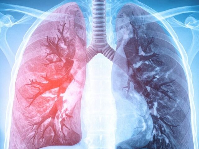 Terapias com Células Estaminais na Fibrose Pulmonar: Uma Intervenção Emergente A fibrose pulmonar (FP) é uma doença pulmonar progressiva caracterizada por remodelação do parênquima e depósito excessivo de tecido fibrótico, resultando numa deterioração da função respiratória e num agravamento clínico contínuo. As opções terapêuticas atuais conseguem apenas retardar a progressão da doença, não sendo capazes de reverter o processo de fibrose estabelecido, o que evidencia a necessidade de abordagens terapêuticas inovadoras e eficazes. As terapias baseadas em células estaminais representaram uma nova direção de investigação nos últimos anos, em especial as que utilizam células estaminais mesenquimais (MSCs). Estas células multipotentes, obtidas de diferentes fontes como medula óssea, tecido adiposo, placenta e sangue do cordão umbilical, exibem propriedades anti-inflamatórias, imunomoduladoras e reparadoras que as tornam candidatas promissoras no contexto de doenças com componente inflamatória e degenerativa, como a Fibrose Pulmonar. A revisão sistemática dos ensaios clínicos registados até ao final de 2024 revelou um crescente interesse global na investigação de terapias com células estaminais para Fibrose Pulmonar. Diferentes tipos de células estaminais mesenquimais foram avaliados em estudos clínicos em fase inicial, administrados por via intravenosa, endobrônquica ou intratraqueal, com foco na sua capacidade de atingir o tecido pulmonar lesado e modular respostas fisiopatológicas críticas. Os dados disponíveis sugerem que a terapia com células estaminais mesenquimais apresenta um perfil de segurança favorável nos contextos estudados, com os eventos adversos mais frequentemente relatados a ser transitórios e de menor gravidade, como febre ou sintomas ligeiros pós-infusão. Embora as evidências ainda sejam preliminares e os ensaios clínicos de maior dimensão e rigor metodológico sejam necessários, os resultados iniciais indicam um possível efeito benéfico em termos de redução da progressão fibrótica e melhoria de alguns parâmetros funcionais respiratórios. Do ponto de vista translacional, estas abordagens baseadas em células estaminais têm o potencial de complementar os tratamentos farmacológicos existentes, não apenas mitigando o processo fibrogénico e a inflamação crónica, mas também promovendo mecanismos de reparação tecidual que não são alcançados com as terapias convencionais. Em conclusão, embora a utilização de terapias com células estaminais na fibrose pulmonar ainda se encontre numa fase emergente de investigação clínica, os resultados disponíveis reforçam o seu potencial enquanto plataforma terapêutica inovadora. A realização de ensaios clínicos de larga escala com critérios de eficácia e segurança mais robustos continua a ser necessário para validar o seu papel na prática clínica e, eventualmente, integrar estas estratégias regenerativas como parte das opções terapêuticas para pacientes com fibrose pulmonar.