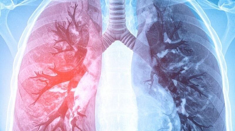 Terapias com Células Estaminais na Fibrose Pulmonar: Uma Intervenção Emergente A fibrose pulmonar (FP) é uma doença pulmonar progressiva caracterizada por remodelação do parênquima e depósito excessivo de tecido fibrótico, resultando numa deterioração da função respiratória e num agravamento clínico contínuo. As opções terapêuticas atuais conseguem apenas retardar a progressão da doença, não sendo capazes de reverter o processo de fibrose estabelecido, o que evidencia a necessidade de abordagens terapêuticas inovadoras e eficazes. As terapias baseadas em células estaminais representaram uma nova direção de investigação nos últimos anos, em especial as que utilizam células estaminais mesenquimais (MSCs). Estas células multipotentes, obtidas de diferentes fontes como medula óssea, tecido adiposo, placenta e sangue do cordão umbilical, exibem propriedades anti-inflamatórias, imunomoduladoras e reparadoras que as tornam candidatas promissoras no contexto de doenças com componente inflamatória e degenerativa, como a Fibrose Pulmonar. A revisão sistemática dos ensaios clínicos registados até ao final de 2024 revelou um crescente interesse global na investigação de terapias com células estaminais para Fibrose Pulmonar. Diferentes tipos de células estaminais mesenquimais foram avaliados em estudos clínicos em fase inicial, administrados por via intravenosa, endobrônquica ou intratraqueal, com foco na sua capacidade de atingir o tecido pulmonar lesado e modular respostas fisiopatológicas críticas. Os dados disponíveis sugerem que a terapia com células estaminais mesenquimais apresenta um perfil de segurança favorável nos contextos estudados, com os eventos adversos mais frequentemente relatados a ser transitórios e de menor gravidade, como febre ou sintomas ligeiros pós-infusão. Embora as evidências ainda sejam preliminares e os ensaios clínicos de maior dimensão e rigor metodológico sejam necessários, os resultados iniciais indicam um possível efeito benéfico em termos de redução da progressão fibrótica e melhoria de alguns parâmetros funcionais respiratórios. Do ponto de vista translacional, estas abordagens baseadas em células estaminais têm o potencial de complementar os tratamentos farmacológicos existentes, não apenas mitigando o processo fibrogénico e a inflamação crónica, mas também promovendo mecanismos de reparação tecidual que não são alcançados com as terapias convencionais. Em conclusão, embora a utilização de terapias com células estaminais na fibrose pulmonar ainda se encontre numa fase emergente de investigação clínica, os resultados disponíveis reforçam o seu potencial enquanto plataforma terapêutica inovadora. A realização de ensaios clínicos de larga escala com critérios de eficácia e segurança mais robustos continua a ser necessário para validar o seu papel na prática clínica e, eventualmente, integrar estas estratégias regenerativas como parte das opções terapêuticas para pacientes com fibrose pulmonar.