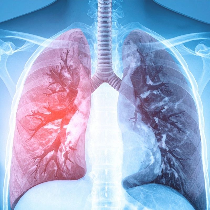 Terapias com Células Estaminais na Fibrose Pulmonar: Uma Intervenção Emergente A fibrose pulmonar (FP) é uma doença pulmonar progressiva caracterizada por remodelação do parênquima e depósito excessivo de tecido fibrótico, resultando numa deterioração da função respiratória e num agravamento clínico contínuo. As opções terapêuticas atuais conseguem apenas retardar a progressão da doença, não sendo capazes de reverter o processo de fibrose estabelecido, o que evidencia a necessidade de abordagens terapêuticas inovadoras e eficazes. As terapias baseadas em células estaminais representaram uma nova direção de investigação nos últimos anos, em especial as que utilizam células estaminais mesenquimais (MSCs). Estas células multipotentes, obtidas de diferentes fontes como medula óssea, tecido adiposo, placenta e sangue do cordão umbilical, exibem propriedades anti-inflamatórias, imunomoduladoras e reparadoras que as tornam candidatas promissoras no contexto de doenças com componente inflamatória e degenerativa, como a Fibrose Pulmonar. A revisão sistemática dos ensaios clínicos registados até ao final de 2024 revelou um crescente interesse global na investigação de terapias com células estaminais para Fibrose Pulmonar. Diferentes tipos de células estaminais mesenquimais foram avaliados em estudos clínicos em fase inicial, administrados por via intravenosa, endobrônquica ou intratraqueal, com foco na sua capacidade de atingir o tecido pulmonar lesado e modular respostas fisiopatológicas críticas. Os dados disponíveis sugerem que a terapia com células estaminais mesenquimais apresenta um perfil de segurança favorável nos contextos estudados, com os eventos adversos mais frequentemente relatados a ser transitórios e de menor gravidade, como febre ou sintomas ligeiros pós-infusão. Embora as evidências ainda sejam preliminares e os ensaios clínicos de maior dimensão e rigor metodológico sejam necessários, os resultados iniciais indicam um possível efeito benéfico em termos de redução da progressão fibrótica e melhoria de alguns parâmetros funcionais respiratórios. Do ponto de vista translacional, estas abordagens baseadas em células estaminais têm o potencial de complementar os tratamentos farmacológicos existentes, não apenas mitigando o processo fibrogénico e a inflamação crónica, mas também promovendo mecanismos de reparação tecidual que não são alcançados com as terapias convencionais. Em conclusão, embora a utilização de terapias com células estaminais na fibrose pulmonar ainda se encontre numa fase emergente de investigação clínica, os resultados disponíveis reforçam o seu potencial enquanto plataforma terapêutica inovadora. A realização de ensaios clínicos de larga escala com critérios de eficácia e segurança mais robustos continua a ser necessário para validar o seu papel na prática clínica e, eventualmente, integrar estas estratégias regenerativas como parte das opções terapêuticas para pacientes com fibrose pulmonar.