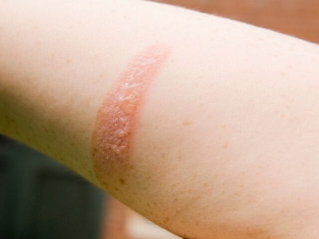 Células estaminais do cordão umbilical mostram potencial no tratamento de queimaduras de segundo grau Uma investigação recente reforça o papel promissor das células estaminais do cordão umbilical na medicina regenerativa, particularmente no tratamento de queimaduras profundas de segundo grau. Cientistas demonstraram que células estaminais mesenquimais derivadas da gelatina de Wharton (tecido do cordão umbilical) podem ser utilizadas para desenvolver pele artificial, promovendo uma regeneração mais rápida e eficaz da pele lesionada. Esta abordagem poderá representar uma alternativa inovadora aos tratamentos convencionais, reduzindo o tempo necessário para intervenção e melhorando a recuperação dos pacientes. Porque é este avanço importante? Atualmente, pacientes com queimaduras graves necessitam frequentemente de enxertos de pele, cuja preparação pode demorar semanas. A utilização de células do cordão umbilical poderá permitir: · Disponibilidade mais imediata de tecido regenerativo · Recuperação acelerada · Menor risco de complicações · Potencial melhoria estética e funcional da pele reparada O potencial das células do cordão vai além das doenças hematológicas Embora as células estaminais do cordão umbilical sejam já reconhecidas no tratamento de várias patologias sanguíneas, este tipo de investigação expande as possibilidades para novas áreas, como: · Medicina regenerativa · Reparação de tecidos · Tratamento de queimaduras · Engenharia de tecidos Uma esperança crescente para o futuro Este avanço reforça a importância da preservação das células estaminais do cordão umbilical como um recurso valioso para futuras aplicações terapêuticas. À medida que a investigação progride, o seu potencial na reparação e regeneração de tecidos continua a crescer, abrindo novas perspetivas para tratamentos mais eficazes e inovadores. Conclusão As células estaminais do cordão umbilical continuam a demonstrar um enorme potencial terapêutico, agora também na recuperação de queimaduras graves. Esta investigação representa mais um passo importante para o futuro da medicina regenerativa e para o desenvolvimento de soluções clínicas cada vez mais avançadas.