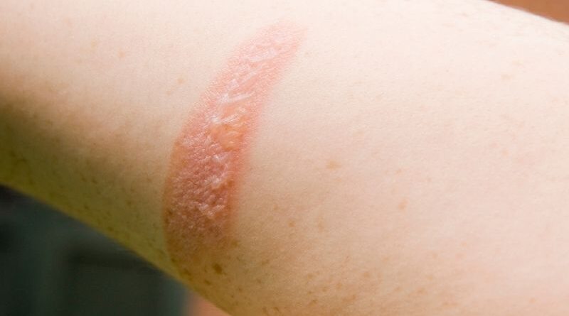 Células estaminais do cordão umbilical mostram potencial no tratamento de queimaduras de segundo grau Uma investigação recente reforça o papel promissor das células estaminais do cordão umbilical na medicina regenerativa, particularmente no tratamento de queimaduras profundas de segundo grau. Cientistas demonstraram que células estaminais mesenquimais derivadas da gelatina de Wharton (tecido do cordão umbilical) podem ser utilizadas para desenvolver pele artificial, promovendo uma regeneração mais rápida e eficaz da pele lesionada. Esta abordagem poderá representar uma alternativa inovadora aos tratamentos convencionais, reduzindo o tempo necessário para intervenção e melhorando a recuperação dos pacientes. Porque é este avanço importante? Atualmente, pacientes com queimaduras graves necessitam frequentemente de enxertos de pele, cuja preparação pode demorar semanas. A utilização de células do cordão umbilical poderá permitir: · Disponibilidade mais imediata de tecido regenerativo · Recuperação acelerada · Menor risco de complicações · Potencial melhoria estética e funcional da pele reparada O potencial das células do cordão vai além das doenças hematológicas Embora as células estaminais do cordão umbilical sejam já reconhecidas no tratamento de várias patologias sanguíneas, este tipo de investigação expande as possibilidades para novas áreas, como: · Medicina regenerativa · Reparação de tecidos · Tratamento de queimaduras · Engenharia de tecidos Uma esperança crescente para o futuro Este avanço reforça a importância da preservação das células estaminais do cordão umbilical como um recurso valioso para futuras aplicações terapêuticas. À medida que a investigação progride, o seu potencial na reparação e regeneração de tecidos continua a crescer, abrindo novas perspetivas para tratamentos mais eficazes e inovadores. Conclusão As células estaminais do cordão umbilical continuam a demonstrar um enorme potencial terapêutico, agora também na recuperação de queimaduras graves. Esta investigação representa mais um passo importante para o futuro da medicina regenerativa e para o desenvolvimento de soluções clínicas cada vez mais avançadas.