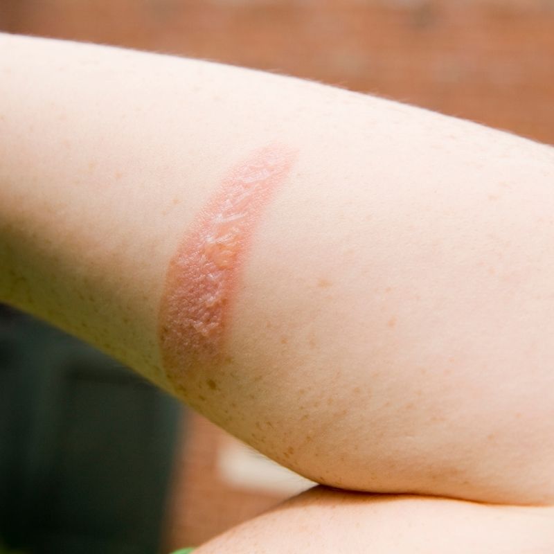 Células estaminais do cordão umbilical mostram potencial no tratamento de queimaduras de segundo grau Uma investigação recente reforça o papel promissor das células estaminais do cordão umbilical na medicina regenerativa, particularmente no tratamento de queimaduras profundas de segundo grau. Cientistas demonstraram que células estaminais mesenquimais derivadas da gelatina de Wharton (tecido do cordão umbilical) podem ser utilizadas para desenvolver pele artificial, promovendo uma regeneração mais rápida e eficaz da pele lesionada. Esta abordagem poderá representar uma alternativa inovadora aos tratamentos convencionais, reduzindo o tempo necessário para intervenção e melhorando a recuperação dos pacientes. Porque é este avanço importante? Atualmente, pacientes com queimaduras graves necessitam frequentemente de enxertos de pele, cuja preparação pode demorar semanas. A utilização de células do cordão umbilical poderá permitir: · Disponibilidade mais imediata de tecido regenerativo · Recuperação acelerada · Menor risco de complicações · Potencial melhoria estética e funcional da pele reparada O potencial das células do cordão vai além das doenças hematológicas Embora as células estaminais do cordão umbilical sejam já reconhecidas no tratamento de várias patologias sanguíneas, este tipo de investigação expande as possibilidades para novas áreas, como: · Medicina regenerativa · Reparação de tecidos · Tratamento de queimaduras · Engenharia de tecidos Uma esperança crescente para o futuro Este avanço reforça a importância da preservação das células estaminais do cordão umbilical como um recurso valioso para futuras aplicações terapêuticas. À medida que a investigação progride, o seu potencial na reparação e regeneração de tecidos continua a crescer, abrindo novas perspetivas para tratamentos mais eficazes e inovadores. Conclusão As células estaminais do cordão umbilical continuam a demonstrar um enorme potencial terapêutico, agora também na recuperação de queimaduras graves. Esta investigação representa mais um passo importante para o futuro da medicina regenerativa e para o desenvolvimento de soluções clínicas cada vez mais avançadas.