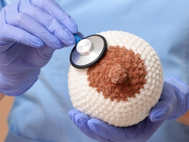 Exossomas do cordão umbilical nova abordagem promissora no tratamento do cancro da mama O cancro da mama continua a ser, a nível mundial, o tipo de cancro com maior incidência e mortalidade entre as mulheres. Apesar dos avanços registados na oncologia nas últimas décadas, persistem desafios importantes, sobretudo no que diz respeito aos efeitos secundários da quimioterapia convencional e à resistência de algumas células tumorais aos tratamentos disponíveis. Neste contexto, os exossomas isolados de células estaminais mesenquimais, em particular os derivados do cordão umbilical humano, têm vindo a destacar-se como uma abordagem inovadora em investigação. Estas pequenas vesículas apresentam características que as tornam especialmente promissoras do ponto de vista terapêutico, nomeadamente elevada compatibilidade biológica, baixa imunogenicidade e capacidade de atravessar barreiras fisiológicas e anatómicas. Estas propriedades permitem-lhes atuar como veículos para o transporte de agentes terapêuticos, como fármacos quimioterápicos, microARN e outros compostos bioativos. De acordo com os dados disponíveis, os exossomas derivados do tecido do cordão umbilical poderão atuar em múltiplas vias de sinalização em simultâneo, contribuindo para inibir o crescimento e a progressão tumoral. Estudos pré-clínicos indicam ainda que podem reduzir a migração e invasão das células tumorais, induzir a morte celular e modular a resposta imunitária. Esta abordagem poderá representar uma nova oportunidade para o desenvolvimento de terapias mais direcionadas no tratamento do cancro da mama, especialmente tendo em conta as limitações das opções terapêuticas atuais. No entanto, continuam a existir desafios relevantes à sua aplicação clínica. Entre eles destacam-se a ausência de métodos padronizados para o isolamento de exossomas, a variabilidade na sua produção e composição e a necessidade de aprofundar o conhecimento sobre o seu comportamento biológico, uma vez que, em determinados contextos, poderão também ter um papel na promoção tumoral. Apesar destas limitações, os exossomas derivados do cordão umbilical surgem como uma abordagem promissora no desenvolvimento de terapias acelulares com potencial antitumoral. Nota: o estudo referido não foi realizado com sangue do cordão umbilical para uso autólogo eventual. Segundo a Sociedade Espanhola de Hematologia e Hemoterapia, a probabilidade de utilização de uma unidade de sangue do cordão autólogo para transplante é atualmente reduzida e não existe ainda evidência clara da sua aplicação futura em medicina regenerativa fora das indicações atualmente estabelecidas.