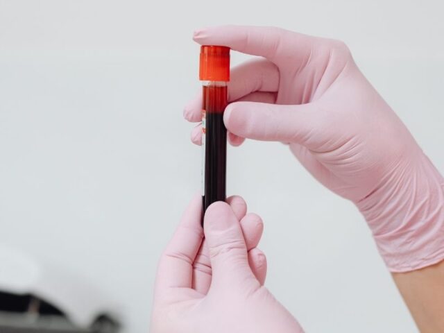 Sangue do cordão umbilical no tratamento da anemia de Diamond-Blackfan Uma análise retrospetiva publicada na revista Bone Marrow Transplantation avaliou crianças com anemia de Diamond-Blackfan submetidas a transplante de sangue do cordão umbilical. Atualmente, a probabilidade de utilização autóloga — ou seja, do próprio sangue do cordão — para transplante é considerada muito baixa, estando sobretudo limitada a algumas patologias pediátricas específicas, como aplasia medular adquirida, tumores sólidos de alto risco e determinados linfomas não Hodgkin em segunda remissão. A anemia de Diamond-Blackfan é uma síndrome hereditária rara de insuficiência da medula óssea, caracterizada por anemia macrocítica e, em alguns casos, por malformações físicas. O único tratamento curativo atualmente disponível para estes doentes é o transplante de células hematopoiéticas. Neste estudo retrospetivo, foram analisados 41 doentes pediátricos com anemia de Diamond-Blackfan que realizaram transplante de sangue do cordão umbilical entre 1994 e 2023, com dados provenientes do registo Eurocord/EBMT. Destes, 20 receberam sangue do cordão de um dador familiar e 21 de um dador não familiar. Os resultados foram particularmente favoráveis nos casos em que o dador era familiar. Neste grupo, a taxa de recuperação neutrofílica ao dia +42 foi de 100% e a sobrevivência global aos 5 anos também foi de 100%. Já nos transplantes com dador não familiar, a recuperação neutrofílica ao dia +42 foi de 90% e a sobrevivência global aos 5 anos foi de 66%. O estudo conclui que o transplante de sangue do cordão umbilical de um irmão HLA-idêntico deve ser considerado em doentes com anemia de Diamond-Blackfan, tendo em conta os resultados positivos a curto e longo prazo. Nos restantes casos, o transplante com dador não familiar poderá ser ponderado, mas sempre após uma avaliação individualizada do risco-benefício. Este estudo reforça o potencial terapêutico do sangue do cordão umbilical em determinadas doenças hematológicas pediátricas, sobretudo quando existe compatibilidade familiar, destacando a importância de avaliar cada caso de forma individualizada.