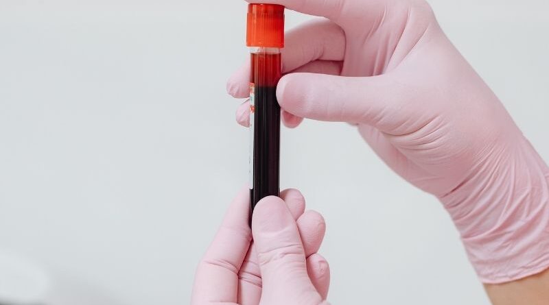 Sangue do cordão umbilical no tratamento da anemia de Diamond-Blackfan Uma análise retrospetiva publicada na revista Bone Marrow Transplantation avaliou crianças com anemia de Diamond-Blackfan submetidas a transplante de sangue do cordão umbilical. Atualmente, a probabilidade de utilização autóloga — ou seja, do próprio sangue do cordão — para transplante é considerada muito baixa, estando sobretudo limitada a algumas patologias pediátricas específicas, como aplasia medular adquirida, tumores sólidos de alto risco e determinados linfomas não Hodgkin em segunda remissão. A anemia de Diamond-Blackfan é uma síndrome hereditária rara de insuficiência da medula óssea, caracterizada por anemia macrocítica e, em alguns casos, por malformações físicas. O único tratamento curativo atualmente disponível para estes doentes é o transplante de células hematopoiéticas. Neste estudo retrospetivo, foram analisados 41 doentes pediátricos com anemia de Diamond-Blackfan que realizaram transplante de sangue do cordão umbilical entre 1994 e 2023, com dados provenientes do registo Eurocord/EBMT. Destes, 20 receberam sangue do cordão de um dador familiar e 21 de um dador não familiar. Os resultados foram particularmente favoráveis nos casos em que o dador era familiar. Neste grupo, a taxa de recuperação neutrofílica ao dia +42 foi de 100% e a sobrevivência global aos 5 anos também foi de 100%. Já nos transplantes com dador não familiar, a recuperação neutrofílica ao dia +42 foi de 90% e a sobrevivência global aos 5 anos foi de 66%. O estudo conclui que o transplante de sangue do cordão umbilical de um irmão HLA-idêntico deve ser considerado em doentes com anemia de Diamond-Blackfan, tendo em conta os resultados positivos a curto e longo prazo. Nos restantes casos, o transplante com dador não familiar poderá ser ponderado, mas sempre após uma avaliação individualizada do risco-benefício. Este estudo reforça o potencial terapêutico do sangue do cordão umbilical em determinadas doenças hematológicas pediátricas, sobretudo quando existe compatibilidade familiar, destacando a importância de avaliar cada caso de forma individualizada.