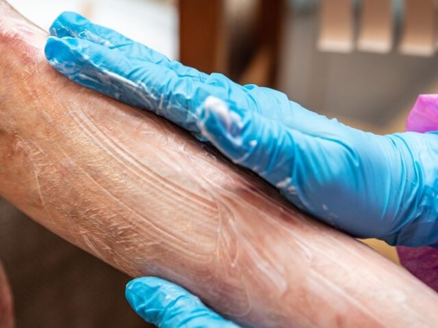 Células do cordão em estudo para uma doença rara da pele Um ensaio clínico publicado em 2025 na revista científica eClinicalMedicine avaliou a segurança e o potencial terapêutico das células estaminais mesenquimais derivadas do tecido do cordão umbilical em crianças com epidermólise bolhosa distrófica recessiva. Esta doença genética rara torna a pele extremamente frágil, provocando bolhas, feridas, cicatrizes, dor e comichão. Embora o estudo não tenha demonstrado melhorias significativas no seu principal indicador de eficácia, confirmou que as células foram bem toleradas e forneceu dados importantes para o desenvolvimento de futuras investigações. O que é a epidermólise bolhosa? A epidermólise bolhosa é um grupo de doenças genéticas raras caracterizadas por uma fragilidade extrema da pele e das mucosas. Nas pessoas afetadas, um pequeno toque ou atrito pode ser suficiente para provocar bolhas e feridas. Uma das formas mais graves é a epidermólise bolhosa distrófica recessiva. Esta doença é causada por alterações genéticas que afetam a produção de colagénio tipo VII, uma proteína essencial para manter unidas as diferentes camadas da pele. As crianças podem apresentar feridas recorrentes, cicatrizes, dor, comichão intensa e dificuldades ao nível da alimentação e da mobilidade. A necessidade constante de cuidados e pensos pode ainda ter um impacto muito significativo na qualidade de vida das crianças e das suas famílias. Atualmente, os cuidados passam sobretudo pelo tratamento das feridas, controlo da dor, prevenção de infeções e acompanhamento das possíveis complicações. Porquê estudar células do cordão umbilical? O tecido do cordão umbilical é uma fonte de células estaminais mesenquimais, também designadas células estromais mesenquimais. Estas células têm sido estudadas pelas suas propriedades imunomoduladoras, anti-inflamatórias e regenerativas. Acredita-se que possam libertar moléculas e fatores de crescimento capazes de reduzir a inflamação, apoiar a cicatrização e contribuir para a reparação dos tecidos. Investigações anteriores sugeriram que a administração intravenosa destas células poderia ajudar a aliviar alguns sintomas da epidermólise bolhosa. No entanto, eram necessários estudos mais robustos e controlados para avaliar a sua segurança e eficácia. Como foi realizado o estudo? O ensaio clínico MissionEB decorreu em dois centros especializados do Reino Unido e envolveu crianças entre os seis meses e os 16 anos com formas intermédias ou graves da doença. No total: 44 crianças foram avaliadas para participar; 37 foram distribuídas aleatoriamente pelos grupos do estudo; 34 receberam pelo menos uma infusão; 30 reuniram os dados necessários para integrar a análise principal. O estudo foi aleatorizado, duplamente cego, controlado por placebo e cruzado. Isto significa que nem as famílias nem as equipas responsáveis pelas avaliações sabiam inicialmente se cada criança estava a receber as células ou o placebo. As crianças receberam duas infusões intravenosas, com 14 dias de intervalo, de células mesenquimais derivadas do tecido do cordão umbilical ou de um placebo. Depois de um intervalo definido no protocolo, os grupos trocaram de intervenção, permitindo que os participantes recebessem ambos em momentos diferentes. Esta metodologia ajudou os investigadores a comparar os resultados do tratamento com os do placebo de uma forma mais rigorosa. Quais foram os resultados? O estudo demonstrou que as infusões foram bem toleradas. Na fase inicial de avaliação não foram identificadas toxicidades inesperadas graves associadas ao tratamento. O principal objetivo relacionado com a eficácia era avaliar se existia uma redução da gravidade da doença, medida através do Índice de Atividade e Cicatrização da Epidermólise Bolhosa, conhecido como EBDASI. Aos três meses, não foram observadas diferenças favoráveis às células estaminais neste indicador principal, quando comparadas com o placebo. Assim, o estudo não demonstrou que o tratamento reduzisse de forma significativa a gravidade global da doença. Algumas análises exploratórias e relatos dos participantes e cuidadores sugeriram possíveis melhorias em sintomas como a comichão, a dor, o estado da pele e o bem-estar quotidiano de algumas crianças. Contudo, estes sinais não são suficientes para confirmar a eficácia do tratamento e deverão ser investigados em novos estudos. Porque é importante este estudo? Mesmo quando um ensaio clínico não alcança o seu principal objetivo de eficácia, os seus resultados podem representar um contributo importante para a ciência. O MissionEB é o maior estudo de terapia celular realizado até ao momento em crianças com epidermólise bolhosa distrófica recessiva. Além de fornecer informação relevante sobre a segurança das células mesenquimais do cordão umbilical, permitiu avaliar de forma mais rigorosa os possíveis benefícios e limitações desta abordagem. Os investigadores destacam também uma dificuldade frequente nos estudos sobre doenças raras: o reduzido número de participantes e a falta de instrumentos totalmente adequados para medir alterações que sejam verdadeiramente relevantes para os doentes. Algumas melhorias sentidas pelas crianças e pelas famílias, como dormir melhor, sentir menos comichão ou conseguir participar mais facilmente nas atividades diárias, podem não ser totalmente captadas pelos indicadores clínicos utilizados. Um caminho que continua em investigação Os resultados não permitem considerar esta terapia um tratamento comprovado para a epidermólise bolhosa. No entanto, demonstram que a administração intravenosa destas células foi segura nas condições avaliadas e ajudam a orientar os próximos passos da investigação. Estão previstas avaliações adicionais para perceber se a administração mais precoce ou repetida poderá ter efeitos diferentes e se determinados grupos de crianças poderão beneficiar mais desta abordagem. Este estudo reforça a importância da investigação clínica rigorosa para compreender o verdadeiro potencial das células estaminais do cordão umbilical, especialmente em doenças raras para as quais continuam a existir poucas opções terapêuticas. As células estaminais mesenquimais descritas neste estudo foram obtidas a partir do tecido do cordão umbilical. Esta aplicação permanece experimental e não constitui atualmente um tratamento comprovado para a epidermólise bolhosa. Fonte: Bageta ML et al. EClinicalMedicine. 2025. PMID: 41181851.