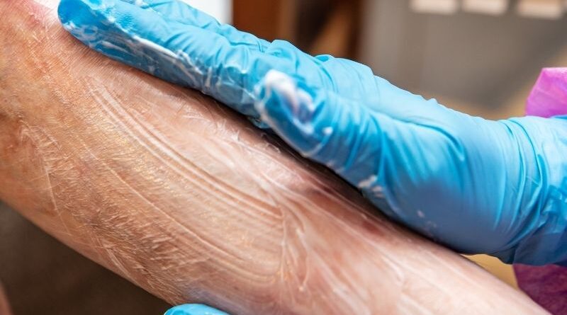 Células do cordão em estudo para uma doença rara da pele Um ensaio clínico publicado em 2025 na revista científica eClinicalMedicine avaliou a segurança e o potencial terapêutico das células estaminais mesenquimais derivadas do tecido do cordão umbilical em crianças com epidermólise bolhosa distrófica recessiva. Esta doença genética rara torna a pele extremamente frágil, provocando bolhas, feridas, cicatrizes, dor e comichão. Embora o estudo não tenha demonstrado melhorias significativas no seu principal indicador de eficácia, confirmou que as células foram bem toleradas e forneceu dados importantes para o desenvolvimento de futuras investigações. O que é a epidermólise bolhosa? A epidermólise bolhosa é um grupo de doenças genéticas raras caracterizadas por uma fragilidade extrema da pele e das mucosas. Nas pessoas afetadas, um pequeno toque ou atrito pode ser suficiente para provocar bolhas e feridas. Uma das formas mais graves é a epidermólise bolhosa distrófica recessiva. Esta doença é causada por alterações genéticas que afetam a produção de colagénio tipo VII, uma proteína essencial para manter unidas as diferentes camadas da pele. As crianças podem apresentar feridas recorrentes, cicatrizes, dor, comichão intensa e dificuldades ao nível da alimentação e da mobilidade. A necessidade constante de cuidados e pensos pode ainda ter um impacto muito significativo na qualidade de vida das crianças e das suas famílias. Atualmente, os cuidados passam sobretudo pelo tratamento das feridas, controlo da dor, prevenção de infeções e acompanhamento das possíveis complicações. Porquê estudar células do cordão umbilical? O tecido do cordão umbilical é uma fonte de células estaminais mesenquimais, também designadas células estromais mesenquimais. Estas células têm sido estudadas pelas suas propriedades imunomoduladoras, anti-inflamatórias e regenerativas. Acredita-se que possam libertar moléculas e fatores de crescimento capazes de reduzir a inflamação, apoiar a cicatrização e contribuir para a reparação dos tecidos. Investigações anteriores sugeriram que a administração intravenosa destas células poderia ajudar a aliviar alguns sintomas da epidermólise bolhosa. No entanto, eram necessários estudos mais robustos e controlados para avaliar a sua segurança e eficácia. Como foi realizado o estudo? O ensaio clínico MissionEB decorreu em dois centros especializados do Reino Unido e envolveu crianças entre os seis meses e os 16 anos com formas intermédias ou graves da doença. No total: 44 crianças foram avaliadas para participar; 37 foram distribuídas aleatoriamente pelos grupos do estudo; 34 receberam pelo menos uma infusão; 30 reuniram os dados necessários para integrar a análise principal. O estudo foi aleatorizado, duplamente cego, controlado por placebo e cruzado. Isto significa que nem as famílias nem as equipas responsáveis pelas avaliações sabiam inicialmente se cada criança estava a receber as células ou o placebo. As crianças receberam duas infusões intravenosas, com 14 dias de intervalo, de células mesenquimais derivadas do tecido do cordão umbilical ou de um placebo. Depois de um intervalo definido no protocolo, os grupos trocaram de intervenção, permitindo que os participantes recebessem ambos em momentos diferentes. Esta metodologia ajudou os investigadores a comparar os resultados do tratamento com os do placebo de uma forma mais rigorosa. Quais foram os resultados? O estudo demonstrou que as infusões foram bem toleradas. Na fase inicial de avaliação não foram identificadas toxicidades inesperadas graves associadas ao tratamento. O principal objetivo relacionado com a eficácia era avaliar se existia uma redução da gravidade da doença, medida através do Índice de Atividade e Cicatrização da Epidermólise Bolhosa, conhecido como EBDASI. Aos três meses, não foram observadas diferenças favoráveis às células estaminais neste indicador principal, quando comparadas com o placebo. Assim, o estudo não demonstrou que o tratamento reduzisse de forma significativa a gravidade global da doença. Algumas análises exploratórias e relatos dos participantes e cuidadores sugeriram possíveis melhorias em sintomas como a comichão, a dor, o estado da pele e o bem-estar quotidiano de algumas crianças. Contudo, estes sinais não são suficientes para confirmar a eficácia do tratamento e deverão ser investigados em novos estudos. Porque é importante este estudo? Mesmo quando um ensaio clínico não alcança o seu principal objetivo de eficácia, os seus resultados podem representar um contributo importante para a ciência. O MissionEB é o maior estudo de terapia celular realizado até ao momento em crianças com epidermólise bolhosa distrófica recessiva. Além de fornecer informação relevante sobre a segurança das células mesenquimais do cordão umbilical, permitiu avaliar de forma mais rigorosa os possíveis benefícios e limitações desta abordagem. Os investigadores destacam também uma dificuldade frequente nos estudos sobre doenças raras: o reduzido número de participantes e a falta de instrumentos totalmente adequados para medir alterações que sejam verdadeiramente relevantes para os doentes. Algumas melhorias sentidas pelas crianças e pelas famílias, como dormir melhor, sentir menos comichão ou conseguir participar mais facilmente nas atividades diárias, podem não ser totalmente captadas pelos indicadores clínicos utilizados. Um caminho que continua em investigação Os resultados não permitem considerar esta terapia um tratamento comprovado para a epidermólise bolhosa. No entanto, demonstram que a administração intravenosa destas células foi segura nas condições avaliadas e ajudam a orientar os próximos passos da investigação. Estão previstas avaliações adicionais para perceber se a administração mais precoce ou repetida poderá ter efeitos diferentes e se determinados grupos de crianças poderão beneficiar mais desta abordagem. Este estudo reforça a importância da investigação clínica rigorosa para compreender o verdadeiro potencial das células estaminais do cordão umbilical, especialmente em doenças raras para as quais continuam a existir poucas opções terapêuticas. As células estaminais mesenquimais descritas neste estudo foram obtidas a partir do tecido do cordão umbilical. Esta aplicação permanece experimental e não constitui atualmente um tratamento comprovado para a epidermólise bolhosa. Fonte: Bageta ML et al. EClinicalMedicine. 2025. PMID: 41181851.