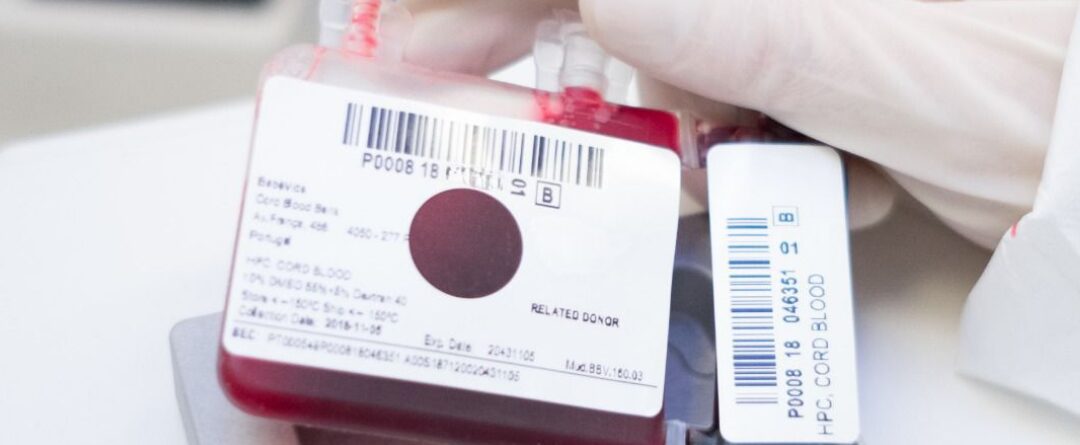 Expansão do sangue do cordão reforça potencial nos transplantes de células estaminais Um estudo publicado em 2025 na revista científica Transplantation and Cellular Therapy apresenta novos dados sobre a utilização de sangue do cordão umbilical expandido em laboratório em transplantes de células estaminais hematopoiéticas. Os investigadores compararam os resultados obtidos com sangue do cordão expandido através da tecnologia UM171 com seis outras fontes de células habitualmente utilizadas em transplante, concluindo que esta abordagem apresentou resultados equivalentes ou, em alguns parâmetros, mais favoráveis. O desafio da quantidade de células no sangue do cordão O sangue do cordão umbilical é uma importante fonte de células estaminais hematopoiéticas, capazes de dar origem às diferentes células do sangue e do sistema imunitário. Estas células são utilizadas há várias décadas no tratamento de diferentes doenças hematológicas. No entanto, uma das limitações associadas ao transplante de sangue do cordão, sobretudo em adultos, é a quantidade de células disponível numa única unidade. É precisamente neste ponto que a expansão celular pode assumir particular relevância. A UM171 é uma pequena molécula utilizada durante o processo de expansão ex vivo, ou seja, em laboratório, com o objetivo de aumentar o número de células estaminais e progenitoras hematopoiéticas antes do transplante. Em estudos clínicos anteriores, esta estratégia já tinha demonstrado ser capaz de expandir unidades de sangue do cordão de menor dimensão, permitindo a realização do transplante sem comprometer a enxertia. Comparação com seis fontes diferentes de células Neste novo trabalho, 22 adultos receberam um transplante com uma única unidade de sangue do cordão expandida com UM171. Os resultados foram depois comparados com dados de doentes registados na European Society for Blood and Marrow Transplantation (EBMT) que tinham recebido transplantes de sangue do cordão não expandido, medula óssea e células estaminais do sangue periférico provenientes de diferentes tipos de dadores. De acordo com os investigadores, os doentes transplantados com sangue do cordão expandido com UM171 apresentaram resultados a curto e longo prazo equivalentes ou superiores aos observados com outras fontes de células estaminais. No grupo que recebeu sangue do cordão expandido com UM171 não foram registados casos moderados a graves desta complicação, tendo sido observadas taxas significativamente inferiores às verificadas em alguns dos grupos de comparação. O estudo avaliou ainda parâmetros como a enxertia, mortalidade não relacionada com recaída, recaída da doença, sobrevivência global, sobrevivência livre de progressão e sobrevivência sem recaída nem GVHD. No conjunto, os resultados positivos reforçam a possibilidade de a expansão celular ajudar a ultrapassar uma das principais limitações históricas do sangue do cordão: a dose celular disponível para transplante. Novas possibilidades para o sangue do cordão A possibilidade de expandir células do sangue do cordão pode tornar utilizáveis unidades que, devido à sua menor quantidade inicial de células, poderiam não ser consideradas adequadas para determinados doentes. Esta evolução é particularmente relevante porque permite continuar a explorar as características próprias do sangue do cordão enquanto fonte de células estaminais hematopoiéticas, ao mesmo tempo que procura ultrapassar algumas das limitações associadas ao número inicial de células. Apesar dos resultados positivos, é importante salientar que este foi um estudo retrospetivo e com um número reduzido de doentes tratados com sangue do cordão expandido. Os resultados devem, por isso, continuar a ser confirmados através de estudos clínicos de maior dimensão. Ainda assim, esta investigação demonstra como a evolução das tecnologias de expansão celular pode abrir novas possibilidades para a utilização do sangue do cordão umbilical e reforça a importância da investigação contínua nesta área. Fonte: Cohen S. et al. Transplantation and Cellular Therapy, 2025. PMID: 40818826.