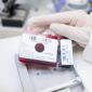 Expansão do sangue do cordão reforça potencial nos transplantes de células estaminais Um estudo publicado em 2025 na revista científica Transplantation and Cellular Therapy apresenta novos dados sobre a utilização de sangue do cordão umbilical expandido em laboratório em transplantes de células estaminais hematopoiéticas. Os investigadores compararam os resultados obtidos com sangue do cordão expandido através da tecnologia UM171 com seis outras fontes de células habitualmente utilizadas em transplante, concluindo que esta abordagem apresentou resultados equivalentes ou, em alguns parâmetros, mais favoráveis. O desafio da quantidade de células no sangue do cordão O sangue do cordão umbilical é uma importante fonte de células estaminais hematopoiéticas, capazes de dar origem às diferentes células do sangue e do sistema imunitário. Estas células são utilizadas há várias décadas no tratamento de diferentes doenças hematológicas. No entanto, uma das limitações associadas ao transplante de sangue do cordão, sobretudo em adultos, é a quantidade de células disponível numa única unidade. É precisamente neste ponto que a expansão celular pode assumir particular relevância. A UM171 é uma pequena molécula utilizada durante o processo de expansão ex vivo, ou seja, em laboratório, com o objetivo de aumentar o número de células estaminais e progenitoras hematopoiéticas antes do transplante. Em estudos clínicos anteriores, esta estratégia já tinha demonstrado ser capaz de expandir unidades de sangue do cordão de menor dimensão, permitindo a realização do transplante sem comprometer a enxertia. Comparação com seis fontes diferentes de células Neste novo trabalho, 22 adultos receberam um transplante com uma única unidade de sangue do cordão expandida com UM171. Os resultados foram depois comparados com dados de doentes registados na European Society for Blood and Marrow Transplantation (EBMT) que tinham recebido transplantes de sangue do cordão não expandido, medula óssea e células estaminais do sangue periférico provenientes de diferentes tipos de dadores. De acordo com os investigadores, os doentes transplantados com sangue do cordão expandido com UM171 apresentaram resultados a curto e longo prazo equivalentes ou superiores aos observados com outras fontes de células estaminais. No grupo que recebeu sangue do cordão expandido com UM171 não foram registados casos moderados a graves desta complicação, tendo sido observadas taxas significativamente inferiores às verificadas em alguns dos grupos de comparação. O estudo avaliou ainda parâmetros como a enxertia, mortalidade não relacionada com recaída, recaída da doença, sobrevivência global, sobrevivência livre de progressão e sobrevivência sem recaída nem GVHD. No conjunto, os resultados positivos reforçam a possibilidade de a expansão celular ajudar a ultrapassar uma das principais limitações históricas do sangue do cordão: a dose celular disponível para transplante. Novas possibilidades para o sangue do cordão A possibilidade de expandir células do sangue do cordão pode tornar utilizáveis unidades que, devido à sua menor quantidade inicial de células, poderiam não ser consideradas adequadas para determinados doentes. Esta evolução é particularmente relevante porque permite continuar a explorar as características próprias do sangue do cordão enquanto fonte de células estaminais hematopoiéticas, ao mesmo tempo que procura ultrapassar algumas das limitações associadas ao número inicial de células. Apesar dos resultados positivos, é importante salientar que este foi um estudo retrospetivo e com um número reduzido de doentes tratados com sangue do cordão expandido. Os resultados devem, por isso, continuar a ser confirmados através de estudos clínicos de maior dimensão. Ainda assim, esta investigação demonstra como a evolução das tecnologias de expansão celular pode abrir novas possibilidades para a utilização do sangue do cordão umbilical e reforça a importância da investigação contínua nesta área. Fonte: Cohen S. et al. Transplantation and Cellular Therapy, 2025. PMID: 40818826.