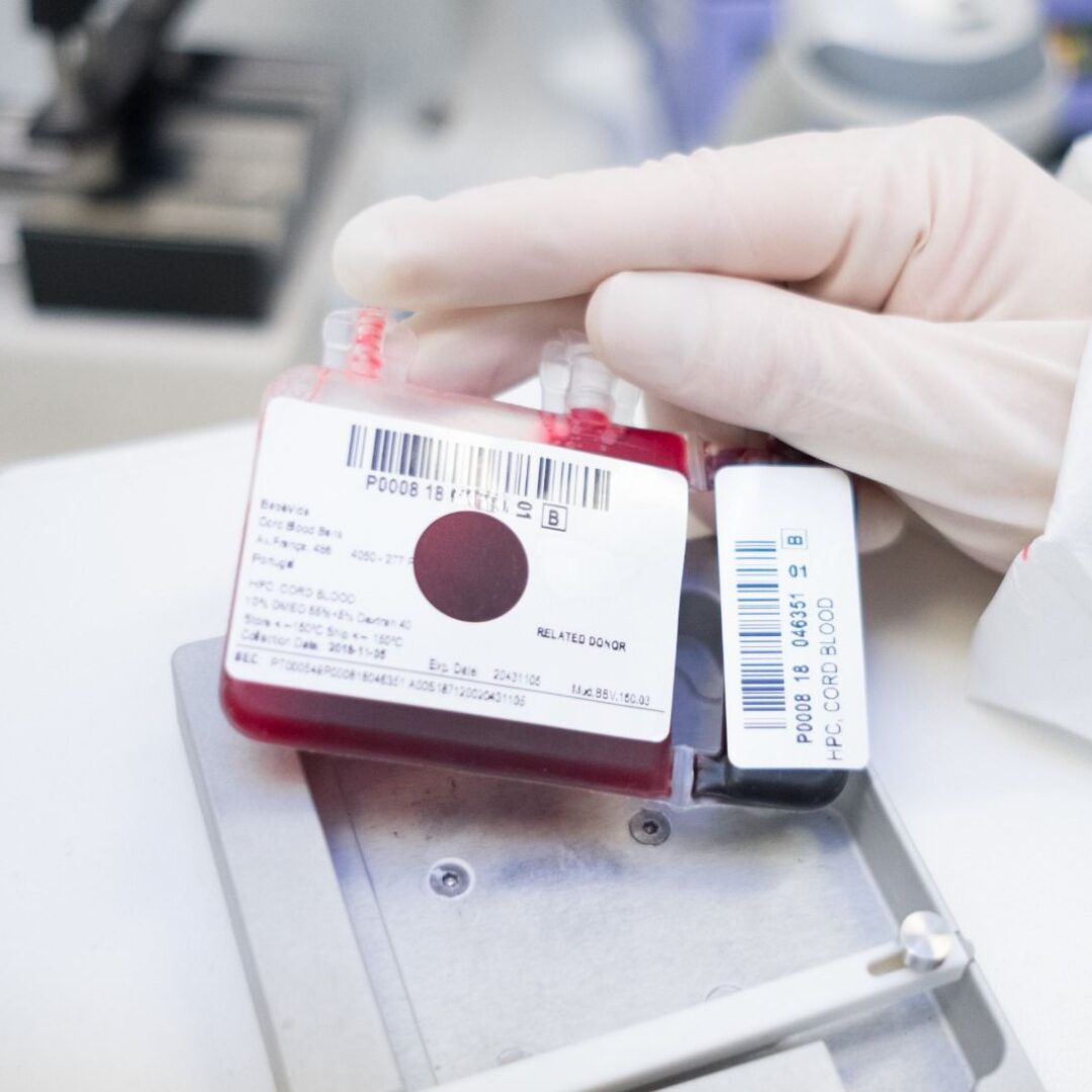 Expansão do sangue do cordão reforça potencial nos transplantes de células estaminais Um estudo publicado em 2025 na revista científica Transplantation and Cellular Therapy apresenta novos dados sobre a utilização de sangue do cordão umbilical expandido em laboratório em transplantes de células estaminais hematopoiéticas. Os investigadores compararam os resultados obtidos com sangue do cordão expandido através da tecnologia UM171 com seis outras fontes de células habitualmente utilizadas em transplante, concluindo que esta abordagem apresentou resultados equivalentes ou, em alguns parâmetros, mais favoráveis. O desafio da quantidade de células no sangue do cordão O sangue do cordão umbilical é uma importante fonte de células estaminais hematopoiéticas, capazes de dar origem às diferentes células do sangue e do sistema imunitário. Estas células são utilizadas há várias décadas no tratamento de diferentes doenças hematológicas. No entanto, uma das limitações associadas ao transplante de sangue do cordão, sobretudo em adultos, é a quantidade de células disponível numa única unidade. É precisamente neste ponto que a expansão celular pode assumir particular relevância. A UM171 é uma pequena molécula utilizada durante o processo de expansão ex vivo, ou seja, em laboratório, com o objetivo de aumentar o número de células estaminais e progenitoras hematopoiéticas antes do transplante. Em estudos clínicos anteriores, esta estratégia já tinha demonstrado ser capaz de expandir unidades de sangue do cordão de menor dimensão, permitindo a realização do transplante sem comprometer a enxertia. Comparação com seis fontes diferentes de células Neste novo trabalho, 22 adultos receberam um transplante com uma única unidade de sangue do cordão expandida com UM171. Os resultados foram depois comparados com dados de doentes registados na European Society for Blood and Marrow Transplantation (EBMT) que tinham recebido transplantes de sangue do cordão não expandido, medula óssea e células estaminais do sangue periférico provenientes de diferentes tipos de dadores. De acordo com os investigadores, os doentes transplantados com sangue do cordão expandido com UM171 apresentaram resultados a curto e longo prazo equivalentes ou superiores aos observados com outras fontes de células estaminais. No grupo que recebeu sangue do cordão expandido com UM171 não foram registados casos moderados a graves desta complicação, tendo sido observadas taxas significativamente inferiores às verificadas em alguns dos grupos de comparação. O estudo avaliou ainda parâmetros como a enxertia, mortalidade não relacionada com recaída, recaída da doença, sobrevivência global, sobrevivência livre de progressão e sobrevivência sem recaída nem GVHD. No conjunto, os resultados positivos reforçam a possibilidade de a expansão celular ajudar a ultrapassar uma das principais limitações históricas do sangue do cordão: a dose celular disponível para transplante. Novas possibilidades para o sangue do cordão A possibilidade de expandir células do sangue do cordão pode tornar utilizáveis unidades que, devido à sua menor quantidade inicial de células, poderiam não ser consideradas adequadas para determinados doentes. Esta evolução é particularmente relevante porque permite continuar a explorar as características próprias do sangue do cordão enquanto fonte de células estaminais hematopoiéticas, ao mesmo tempo que procura ultrapassar algumas das limitações associadas ao número inicial de células. Apesar dos resultados positivos, é importante salientar que este foi um estudo retrospetivo e com um número reduzido de doentes tratados com sangue do cordão expandido. Os resultados devem, por isso, continuar a ser confirmados através de estudos clínicos de maior dimensão. Ainda assim, esta investigação demonstra como a evolução das tecnologias de expansão celular pode abrir novas possibilidades para a utilização do sangue do cordão umbilical e reforça a importância da investigação contínua nesta área. Fonte: Cohen S. et al. Transplantation and Cellular Therapy, 2025. PMID: 40818826.