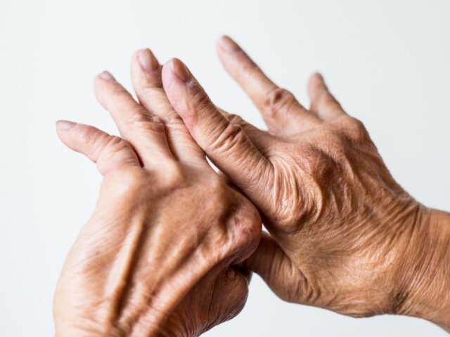 Artrite reumatoide: células estaminais do cordão acompanhadas durante 5 anos Um estudo publicado em agosto de 2026 na revista científica Stem Cells Translational Medicine avaliou, durante cinco anos, a segurança da administração de células estaminais mesenquimais derivadas do sangue do cordão umbilical em pessoas com artrite reumatoide. Os resultados não identificaram novos sinais importantes de segurança associados à terapia celular durante o período de acompanhamento. A artrite reumatoide é uma doença inflamatória crónica e autoimune que afeta principalmente as articulações e que, ao longo do tempo, pode provocar lesões articulares e incapacidade. Apesar dos importantes avanços alcançados com os tratamentos atualmente disponíveis, algumas terapêuticas podem estar associadas a efeitos adversos significativos. Por esse motivo, a investigação continua a explorar novas abordagens, entre as quais as células estaminais mesenquimais, conhecidas pelas suas propriedades imunomoduladoras. Um acompanhamento ao longo de cinco anos O estudo acompanhou nove pessoas com artrite reumatoide que tinham participado anteriormente num ensaio clínico de fase I. Cada participante recebeu uma única administração intravenosa de células estaminais mesenquimais derivadas do sangue do cordão umbilical, em diferentes doses. Após a administração, os investigadores realizaram avaliações aos três, seis e doze meses e, posteriormente, todos os anos até completar cinco anos de acompanhamento. O principal objetivo foi perceber se poderiam surgir efeitos adversos relevantes a longo prazo. O que mostraram os resultados? Durante os cinco anos de acompanhamento, não foram registadas mortes, eventos tromboembólicos ou tumores malignos. Entre os acontecimentos adversos mais frequentes encontraram-se a osteoartrose e a nasofaringite. Foram também registados eventos adversos graves em alguns participantes, incluindo um caso de celulite — uma infeção da pele e tecidos subjacentes — que foi tratado e resolvido. Dois participantes desenvolveram tumores benignos, um do ovário e outro da mama, cerca de três anos após a administração. De acordo com os dados apresentados pelos investigadores, não foram identificados tumores malignos durante o período de acompanhamento. Globalmente, os autores consideram que uma única administração intravenosa destas células apresentou um perfil de segurança a longo prazo aceitável neste pequeno grupo de participantes. E quanto à evolução da artrite reumatoide? Embora o objetivo principal deste estudo fosse avaliar a segurança, os investigadores acompanharam também a atividade da doença. Nos primeiros três a seis meses após a administração das células foi observada uma melhoria marcada no índice utilizado para avaliar a atividade da artrite reumatoide, o DAS28. Contudo, ao longo dos cinco anos seguintes, a atividade da doença voltou gradualmente a aumentar. Estes resultados sugerem que o eventual efeito observado após uma única administração poderá diminuir com o tempo. Os investigadores levantam, por isso, a hipótese de que futuros estudos possam avaliar esquemas com administrações repetidas. Porque são estudadas as células estaminais mesenquimais? As células estaminais mesenquimais têm despertado interesse na investigação de doenças autoimunes sobretudo devido às suas propriedades imunomoduladoras. Em vez de atuarem apenas através da substituição de células danificadas, estas células podem interagir com diferentes componentes do sistema imunitário e influenciar processos relacionados com a inflamação. As células mesenquimais podem ser obtidas a partir de diferentes tecidos. Neste estudo, foram utilizadas especificamente células estaminais mesenquimais derivadas do sangue do cordão umbilical, cuja recolha é não invasiva e que apresentam características que têm motivado a sua investigação em diferentes áreas da medicina regenerativa. Resultados promissores, mas que exigem mais investigação Este estudo acrescenta informação particularmente relevante por acompanhar os participantes durante cinco anos, um período ainda pouco representado nos estudos clínicos com este tipo de terapia celular. No entanto, os próprios investigadores salientam as limitações do trabalho. O estudo incluiu apenas nove participantes, teve carácter exploratório e observacional e não contou com um grupo de controlo durante este acompanhamento. Assim, estes resultados não demonstram que as células estaminais do sangue do cordão umbilical sejam atualmente um tratamento comprovado para a artrite reumatoide. São, contudo, dados importantes sobre a segurança a longo prazo desta abordagem e constituem uma base para estudos futuros, com maior número de participantes e desenhos clínicos controlados. A investigação continua, assim, a explorar o potencial das células estaminais do cordão umbilical em novas áreas terapêuticas e a procurar compreender de que forma as suas propriedades poderão ser utilizadas de forma segura e eficaz no futuro.