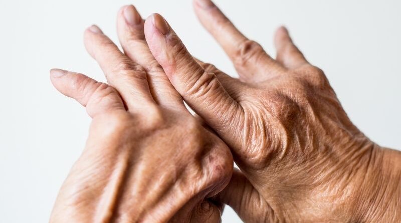 Artrite reumatoide: células estaminais do cordão acompanhadas durante 5 anos Um estudo publicado em agosto de 2026 na revista científica Stem Cells Translational Medicine avaliou, durante cinco anos, a segurança da administração de células estaminais mesenquimais derivadas do sangue do cordão umbilical em pessoas com artrite reumatoide. Os resultados não identificaram novos sinais importantes de segurança associados à terapia celular durante o período de acompanhamento. A artrite reumatoide é uma doença inflamatória crónica e autoimune que afeta principalmente as articulações e que, ao longo do tempo, pode provocar lesões articulares e incapacidade. Apesar dos importantes avanços alcançados com os tratamentos atualmente disponíveis, algumas terapêuticas podem estar associadas a efeitos adversos significativos. Por esse motivo, a investigação continua a explorar novas abordagens, entre as quais as células estaminais mesenquimais, conhecidas pelas suas propriedades imunomoduladoras. Um acompanhamento ao longo de cinco anos O estudo acompanhou nove pessoas com artrite reumatoide que tinham participado anteriormente num ensaio clínico de fase I. Cada participante recebeu uma única administração intravenosa de células estaminais mesenquimais derivadas do sangue do cordão umbilical, em diferentes doses. Após a administração, os investigadores realizaram avaliações aos três, seis e doze meses e, posteriormente, todos os anos até completar cinco anos de acompanhamento. O principal objetivo foi perceber se poderiam surgir efeitos adversos relevantes a longo prazo. O que mostraram os resultados? Durante os cinco anos de acompanhamento, não foram registadas mortes, eventos tromboembólicos ou tumores malignos. Entre os acontecimentos adversos mais frequentes encontraram-se a osteoartrose e a nasofaringite. Foram também registados eventos adversos graves em alguns participantes, incluindo um caso de celulite — uma infeção da pele e tecidos subjacentes — que foi tratado e resolvido. Dois participantes desenvolveram tumores benignos, um do ovário e outro da mama, cerca de três anos após a administração. De acordo com os dados apresentados pelos investigadores, não foram identificados tumores malignos durante o período de acompanhamento. Globalmente, os autores consideram que uma única administração intravenosa destas células apresentou um perfil de segurança a longo prazo aceitável neste pequeno grupo de participantes. E quanto à evolução da artrite reumatoide? Embora o objetivo principal deste estudo fosse avaliar a segurança, os investigadores acompanharam também a atividade da doença. Nos primeiros três a seis meses após a administração das células foi observada uma melhoria marcada no índice utilizado para avaliar a atividade da artrite reumatoide, o DAS28. Contudo, ao longo dos cinco anos seguintes, a atividade da doença voltou gradualmente a aumentar. Estes resultados sugerem que o eventual efeito observado após uma única administração poderá diminuir com o tempo. Os investigadores levantam, por isso, a hipótese de que futuros estudos possam avaliar esquemas com administrações repetidas. Porque são estudadas as células estaminais mesenquimais? As células estaminais mesenquimais têm despertado interesse na investigação de doenças autoimunes sobretudo devido às suas propriedades imunomoduladoras. Em vez de atuarem apenas através da substituição de células danificadas, estas células podem interagir com diferentes componentes do sistema imunitário e influenciar processos relacionados com a inflamação. As células mesenquimais podem ser obtidas a partir de diferentes tecidos. Neste estudo, foram utilizadas especificamente células estaminais mesenquimais derivadas do sangue do cordão umbilical, cuja recolha é não invasiva e que apresentam características que têm motivado a sua investigação em diferentes áreas da medicina regenerativa. Resultados promissores, mas que exigem mais investigação Este estudo acrescenta informação particularmente relevante por acompanhar os participantes durante cinco anos, um período ainda pouco representado nos estudos clínicos com este tipo de terapia celular. No entanto, os próprios investigadores salientam as limitações do trabalho. O estudo incluiu apenas nove participantes, teve carácter exploratório e observacional e não contou com um grupo de controlo durante este acompanhamento. Assim, estes resultados não demonstram que as células estaminais do sangue do cordão umbilical sejam atualmente um tratamento comprovado para a artrite reumatoide. São, contudo, dados importantes sobre a segurança a longo prazo desta abordagem e constituem uma base para estudos futuros, com maior número de participantes e desenhos clínicos controlados. A investigação continua, assim, a explorar o potencial das células estaminais do cordão umbilical em novas áreas terapêuticas e a procurar compreender de que forma as suas propriedades poderão ser utilizadas de forma segura e eficaz no futuro.