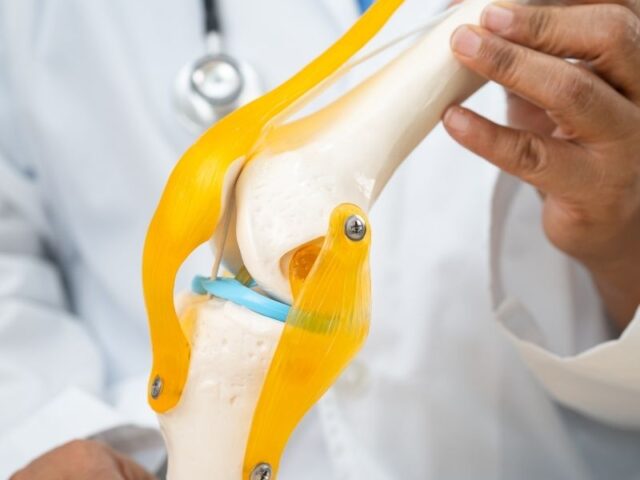 Células estaminais do cordão umbilical mostram resultados promissores na osteoartrose do joelho Um novo ensaio clínico reforça o potencial das células estaminais mesenquimais derivadas do cordão umbilical na investigação de novas abordagens para a osteoartrose do joelho, uma doença degenerativa que afeta a cartilagem e outras estruturas da articulação e que pode provocar dor, inflamação e limitação da mobilidade. Publicado no BMC Musculoskeletal Disorders, o estudo avaliou a segurança e os efeitos clínicos da administração intra-articular de células estaminais mesenquimais derivadas do cordão umbilical (UC-MSCs) em pessoas com osteoartrose do joelho. Tratou-se de um ensaio clínico randomizado, duplamente cego e controlado por placebo, envolvendo 55 participantes distribuídos por três grupos: células mesenquimais do cordão umbilical, ácido hialurónico e placebo. Resultados particularmente relevantes nos doentes com inflamação articular Os participantes receberam uma única injeção intra-articular, sendo administradas 20 milhões de células mesenquimais derivadas do cordão umbilical no grupo experimental. Ao longo dos seis meses seguintes, os investigadores avaliaram diferentes parâmetros relacionados com a dor, função do joelho, qualidade de vida e alterações observadas através de ressonância magnética. Um dos resultados mais relevantes verificou-se nos participantes que, para além da osteoartrose, apresentavam sinovite, ou seja, inflamação da membrana que reveste internamente a articulação. Neste grupo, a administração das células mesenquimais do cordão umbilical esteve associada a uma melhoria significativamente superior da sinovite aos seis meses, comparativamente aos grupos placebo e ácido hialurónico. Foram também observadas melhorias significativas em indicadores de dor, função e qualidade de vida, particularmente nos participantes que apresentavam dor moderada a grave. O potencial das células mesenquimais do cordão umbilical Durante muito tempo, a investigação com células estaminais mesenquimais na osteoartrose esteve especialmente focada na possibilidade de reparação dos tecidos danificados. Atualmente, existe também um interesse crescente nos seus efeitos imunomoduladores e anti-inflamatórios. Estas células podem libertar diferentes moléculas e fatores biologicamente ativos capazes de interagir com o ambiente da articulação, estando a ser estudado o seu potencial para modular processos inflamatórios e proteger os tecidos articulares. Os resultados deste estudo são particularmente interessantes neste contexto, uma vez que sugerem que os doentes com osteoartrose acompanhada de um componente inflamatório, como a sinovite, poderão constituir um grupo especialmente relevante para futuras investigações com células mesenquimais derivadas do cordão umbilical. Uma área ainda em investigação Em termos de segurança, não foram observadas diferenças significativas na ocorrência de eventos adversos entre os três grupos e não foram registados eventos adversos graves relacionados com o tratamento. Os efeitos observados foram sobretudo locais e transitórios. Apesar dos resultados clínicos positivos, a ressonância magnética não revelou diferenças significativas nas restantes estruturas articulares entre os grupos, para além da melhoria observada ao nível da sinovite. Assim, os resultados não permitem concluir que tenha ocorrido regeneração da cartilagem. Os próprios investigadores salientam ainda algumas limitações, nomeadamente o reduzido número de participantes e o período de acompanhamento de apenas seis meses. Serão necessários estudos multicêntricos de maior dimensão, com períodos de acompanhamento mais longos, incluindo ensaios clínicos de fase III, para confirmar a eficácia desta abordagem. Ainda assim, esta investigação acrescenta nova evidência ao estudo das células mesenquimais derivadas do cordão umbilical e reforça o interesse científico em explorar o seu potencial no desenvolvimento de futuras estratégias para doenças articulares degenerativas como a osteoartrose.