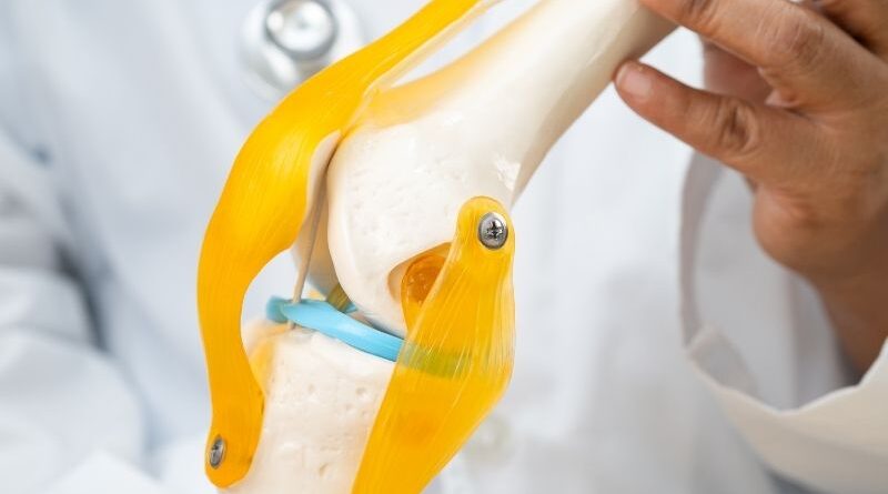 Células estaminais do cordão umbilical mostram resultados promissores na osteoartrose do joelho Um novo ensaio clínico reforça o potencial das células estaminais mesenquimais derivadas do cordão umbilical na investigação de novas abordagens para a osteoartrose do joelho, uma doença degenerativa que afeta a cartilagem e outras estruturas da articulação e que pode provocar dor, inflamação e limitação da mobilidade. Publicado no BMC Musculoskeletal Disorders, o estudo avaliou a segurança e os efeitos clínicos da administração intra-articular de células estaminais mesenquimais derivadas do cordão umbilical (UC-MSCs) em pessoas com osteoartrose do joelho. Tratou-se de um ensaio clínico randomizado, duplamente cego e controlado por placebo, envolvendo 55 participantes distribuídos por três grupos: células mesenquimais do cordão umbilical, ácido hialurónico e placebo. Resultados particularmente relevantes nos doentes com inflamação articular Os participantes receberam uma única injeção intra-articular, sendo administradas 20 milhões de células mesenquimais derivadas do cordão umbilical no grupo experimental. Ao longo dos seis meses seguintes, os investigadores avaliaram diferentes parâmetros relacionados com a dor, função do joelho, qualidade de vida e alterações observadas através de ressonância magnética. Um dos resultados mais relevantes verificou-se nos participantes que, para além da osteoartrose, apresentavam sinovite, ou seja, inflamação da membrana que reveste internamente a articulação. Neste grupo, a administração das células mesenquimais do cordão umbilical esteve associada a uma melhoria significativamente superior da sinovite aos seis meses, comparativamente aos grupos placebo e ácido hialurónico. Foram também observadas melhorias significativas em indicadores de dor, função e qualidade de vida, particularmente nos participantes que apresentavam dor moderada a grave. O potencial das células mesenquimais do cordão umbilical Durante muito tempo, a investigação com células estaminais mesenquimais na osteoartrose esteve especialmente focada na possibilidade de reparação dos tecidos danificados. Atualmente, existe também um interesse crescente nos seus efeitos imunomoduladores e anti-inflamatórios. Estas células podem libertar diferentes moléculas e fatores biologicamente ativos capazes de interagir com o ambiente da articulação, estando a ser estudado o seu potencial para modular processos inflamatórios e proteger os tecidos articulares. Os resultados deste estudo são particularmente interessantes neste contexto, uma vez que sugerem que os doentes com osteoartrose acompanhada de um componente inflamatório, como a sinovite, poderão constituir um grupo especialmente relevante para futuras investigações com células mesenquimais derivadas do cordão umbilical. Uma área ainda em investigação Em termos de segurança, não foram observadas diferenças significativas na ocorrência de eventos adversos entre os três grupos e não foram registados eventos adversos graves relacionados com o tratamento. Os efeitos observados foram sobretudo locais e transitórios. Apesar dos resultados clínicos positivos, a ressonância magnética não revelou diferenças significativas nas restantes estruturas articulares entre os grupos, para além da melhoria observada ao nível da sinovite. Assim, os resultados não permitem concluir que tenha ocorrido regeneração da cartilagem. Os próprios investigadores salientam ainda algumas limitações, nomeadamente o reduzido número de participantes e o período de acompanhamento de apenas seis meses. Serão necessários estudos multicêntricos de maior dimensão, com períodos de acompanhamento mais longos, incluindo ensaios clínicos de fase III, para confirmar a eficácia desta abordagem. Ainda assim, esta investigação acrescenta nova evidência ao estudo das células mesenquimais derivadas do cordão umbilical e reforça o interesse científico em explorar o seu potencial no desenvolvimento de futuras estratégias para doenças articulares degenerativas como a osteoartrose.