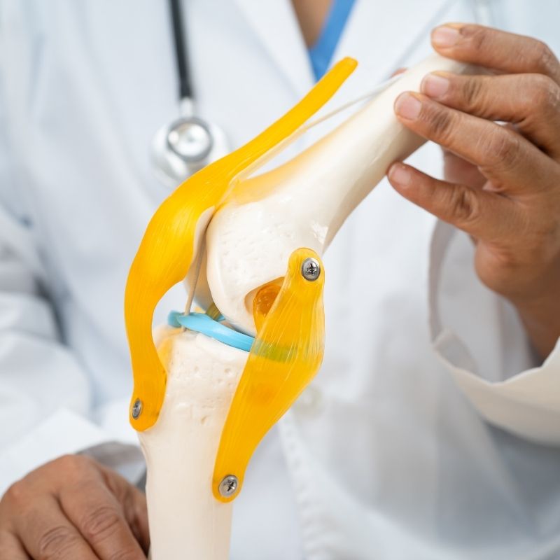 Células estaminais do cordão umbilical mostram resultados promissores na osteoartrose do joelho Um novo ensaio clínico reforça o potencial das células estaminais mesenquimais derivadas do cordão umbilical na investigação de novas abordagens para a osteoartrose do joelho, uma doença degenerativa que afeta a cartilagem e outras estruturas da articulação e que pode provocar dor, inflamação e limitação da mobilidade. Publicado no BMC Musculoskeletal Disorders, o estudo avaliou a segurança e os efeitos clínicos da administração intra-articular de células estaminais mesenquimais derivadas do cordão umbilical (UC-MSCs) em pessoas com osteoartrose do joelho. Tratou-se de um ensaio clínico randomizado, duplamente cego e controlado por placebo, envolvendo 55 participantes distribuídos por três grupos: células mesenquimais do cordão umbilical, ácido hialurónico e placebo. Resultados particularmente relevantes nos doentes com inflamação articular Os participantes receberam uma única injeção intra-articular, sendo administradas 20 milhões de células mesenquimais derivadas do cordão umbilical no grupo experimental. Ao longo dos seis meses seguintes, os investigadores avaliaram diferentes parâmetros relacionados com a dor, função do joelho, qualidade de vida e alterações observadas através de ressonância magnética. Um dos resultados mais relevantes verificou-se nos participantes que, para além da osteoartrose, apresentavam sinovite, ou seja, inflamação da membrana que reveste internamente a articulação. Neste grupo, a administração das células mesenquimais do cordão umbilical esteve associada a uma melhoria significativamente superior da sinovite aos seis meses, comparativamente aos grupos placebo e ácido hialurónico. Foram também observadas melhorias significativas em indicadores de dor, função e qualidade de vida, particularmente nos participantes que apresentavam dor moderada a grave. O potencial das células mesenquimais do cordão umbilical Durante muito tempo, a investigação com células estaminais mesenquimais na osteoartrose esteve especialmente focada na possibilidade de reparação dos tecidos danificados. Atualmente, existe também um interesse crescente nos seus efeitos imunomoduladores e anti-inflamatórios. Estas células podem libertar diferentes moléculas e fatores biologicamente ativos capazes de interagir com o ambiente da articulação, estando a ser estudado o seu potencial para modular processos inflamatórios e proteger os tecidos articulares. Os resultados deste estudo são particularmente interessantes neste contexto, uma vez que sugerem que os doentes com osteoartrose acompanhada de um componente inflamatório, como a sinovite, poderão constituir um grupo especialmente relevante para futuras investigações com células mesenquimais derivadas do cordão umbilical. Uma área ainda em investigação Em termos de segurança, não foram observadas diferenças significativas na ocorrência de eventos adversos entre os três grupos e não foram registados eventos adversos graves relacionados com o tratamento. Os efeitos observados foram sobretudo locais e transitórios. Apesar dos resultados clínicos positivos, a ressonância magnética não revelou diferenças significativas nas restantes estruturas articulares entre os grupos, para além da melhoria observada ao nível da sinovite. Assim, os resultados não permitem concluir que tenha ocorrido regeneração da cartilagem. Os próprios investigadores salientam ainda algumas limitações, nomeadamente o reduzido número de participantes e o período de acompanhamento de apenas seis meses. Serão necessários estudos multicêntricos de maior dimensão, com períodos de acompanhamento mais longos, incluindo ensaios clínicos de fase III, para confirmar a eficácia desta abordagem. Ainda assim, esta investigação acrescenta nova evidência ao estudo das células mesenquimais derivadas do cordão umbilical e reforça o interesse científico em explorar o seu potencial no desenvolvimento de futuras estratégias para doenças articulares degenerativas como a osteoartrose.